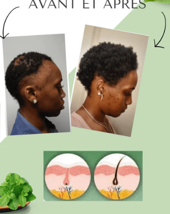 Huile Capillaire Extrem Pousse