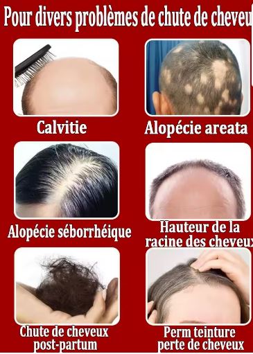 Huile Capillaire Extrem Pousse